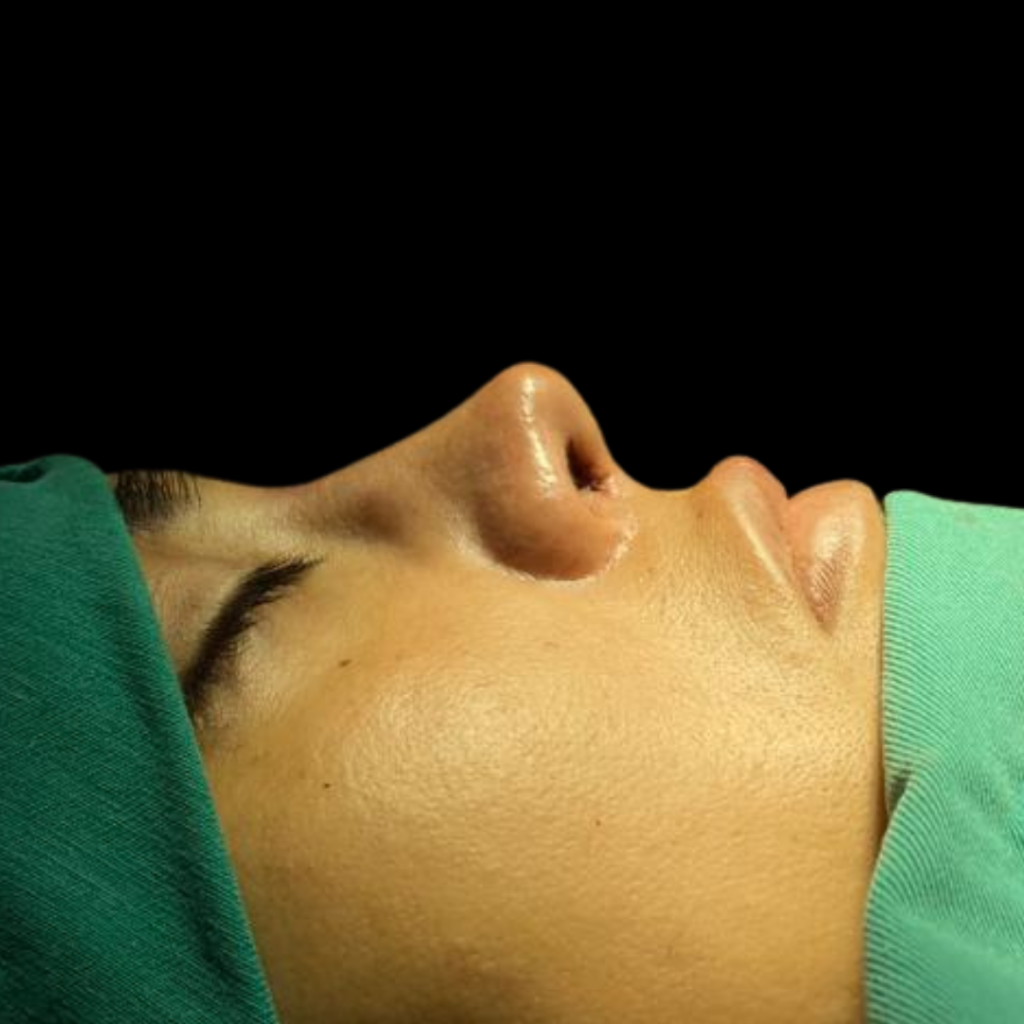 cirugia-endoscópica-nasal