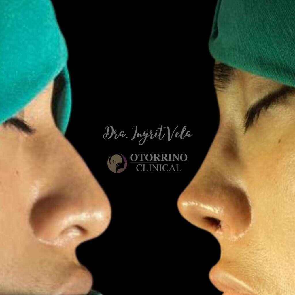 cirugia-estetica-nasal